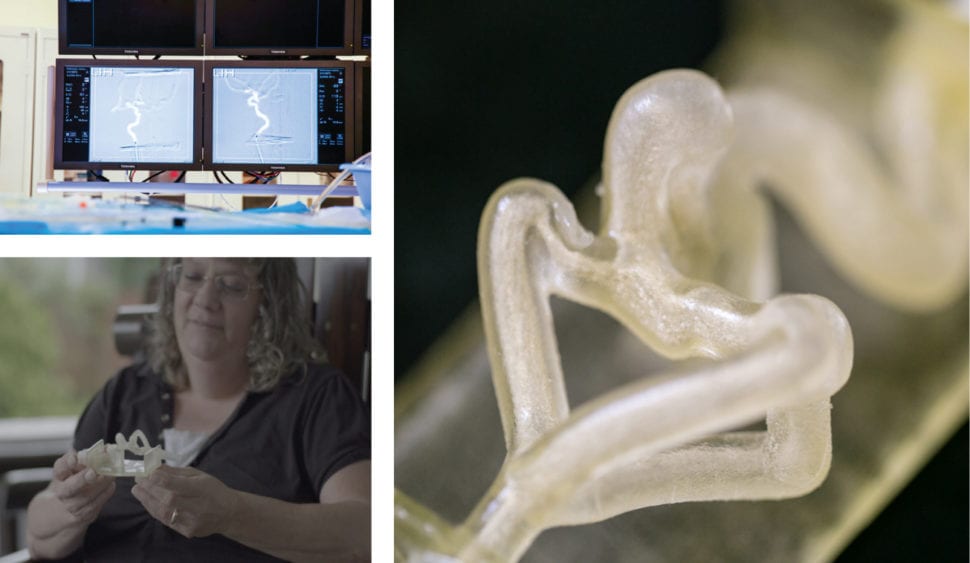 Teresa Flint holds a 3D printed model of her cerebral aneurysm.